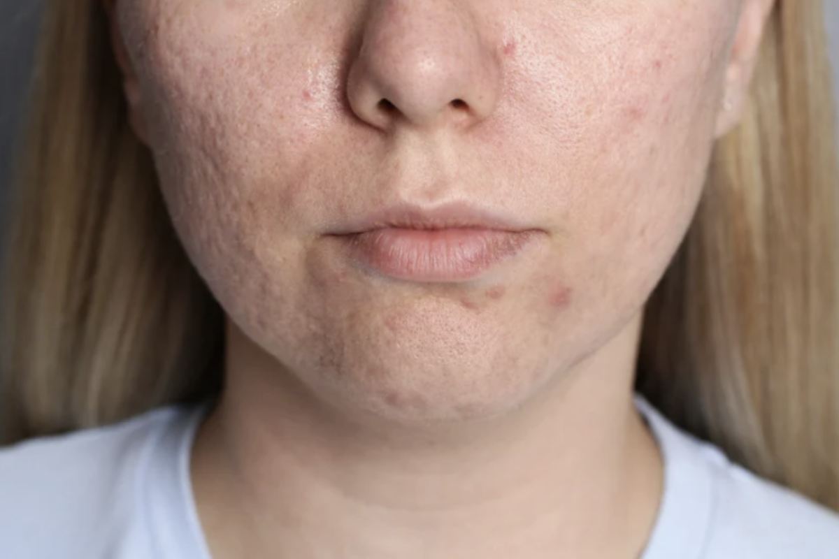 La formazione di brufoli e punti neri, sia sul viso che nell’area delle orecchie, è spesso legata a una produzione eccessiva di sebo